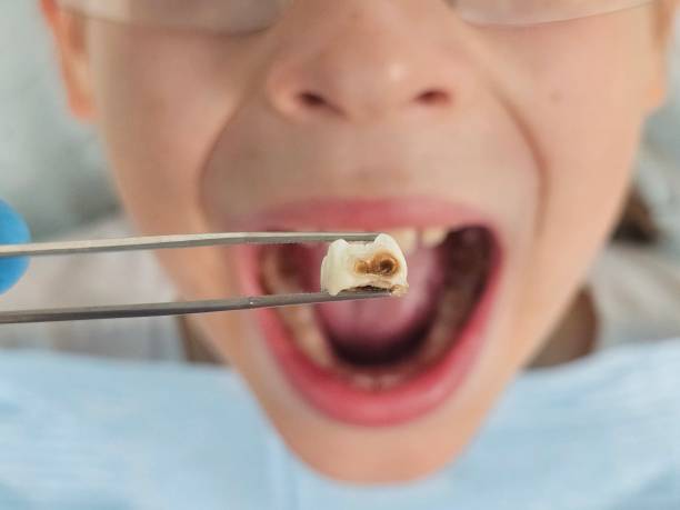 Best Urgent Care for Lost Fillings or Crowns in Kiawah Island, SC